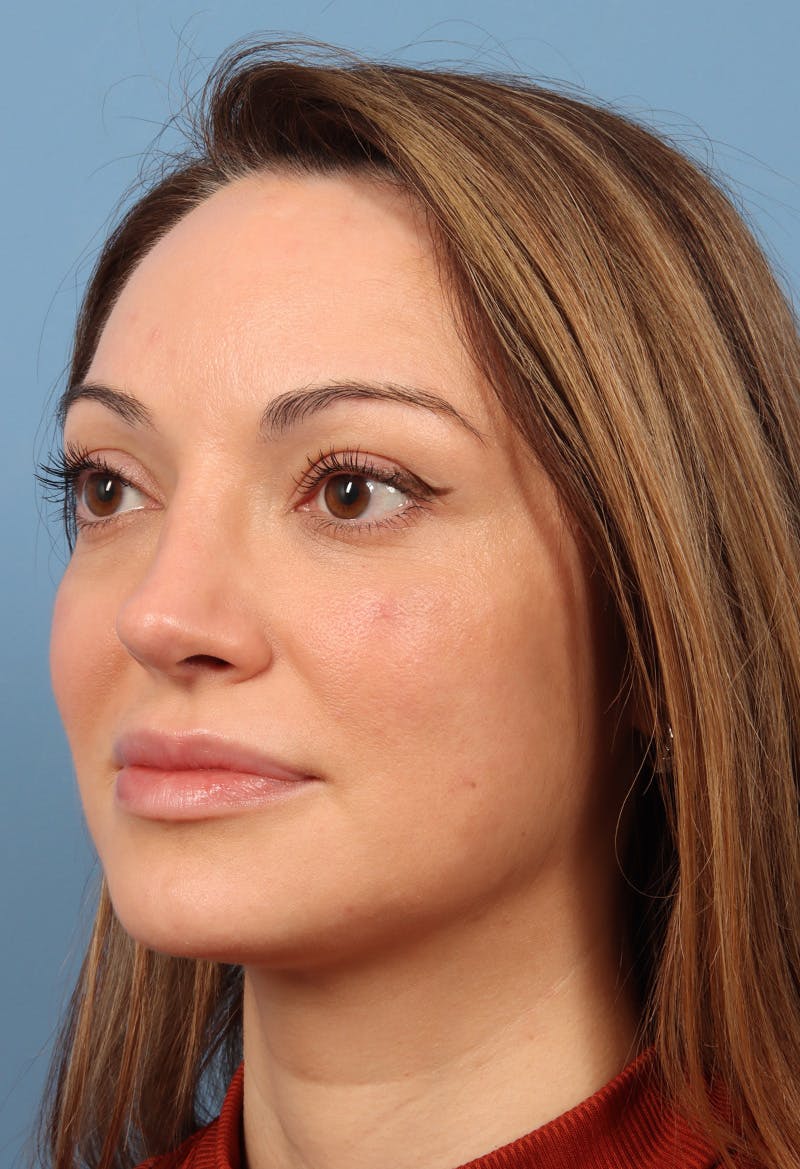 Rhinoplasty Before & After Gallery - Patient 197849 - Image 4