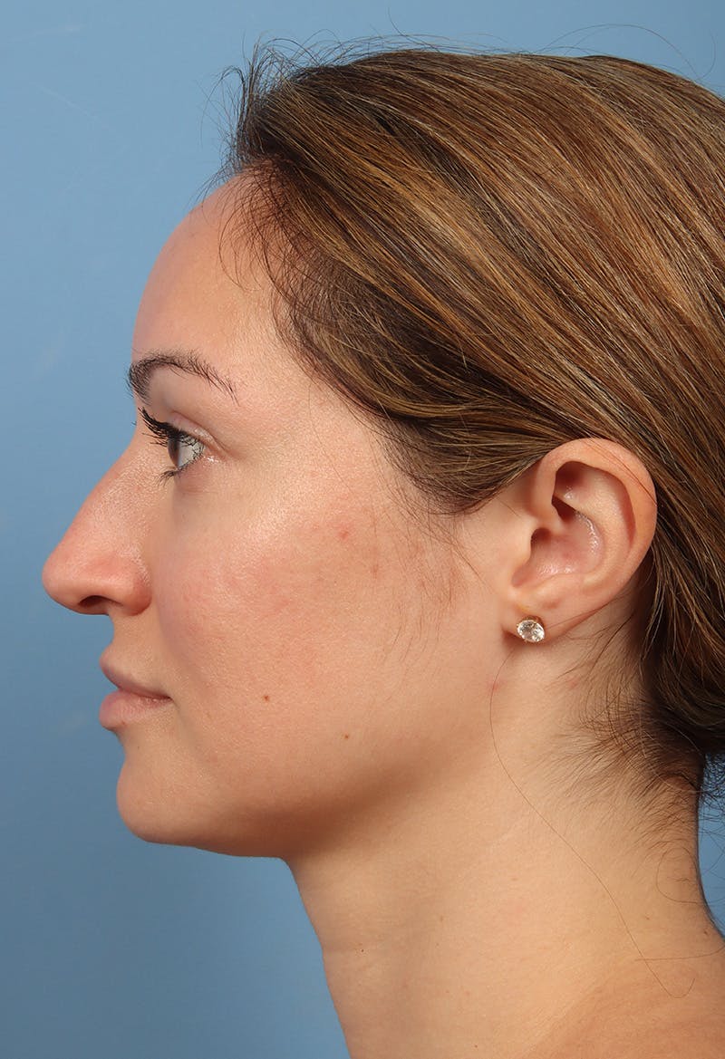 Rhinoplasty Before & After Gallery - Patient 197849 - Image 1