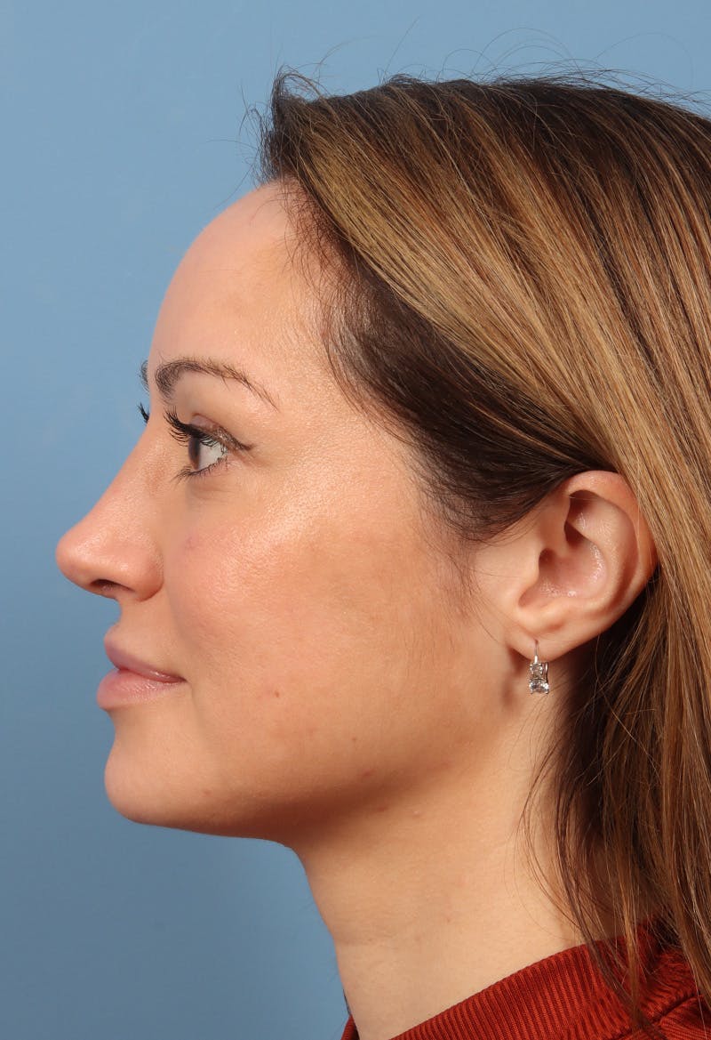 Rhinoplasty Before & After Gallery - Patient 197849 - Image 2
