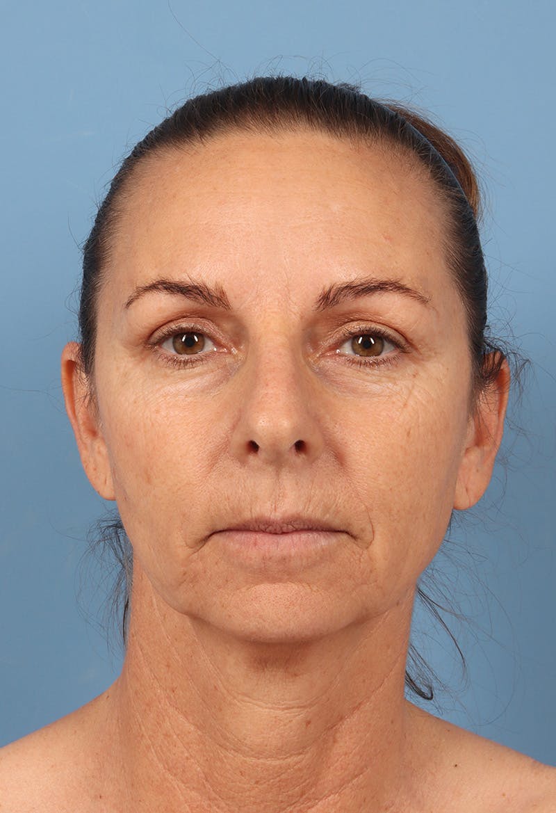 Rhinoplasty Before & After Gallery - Patient 115519 - Image 5