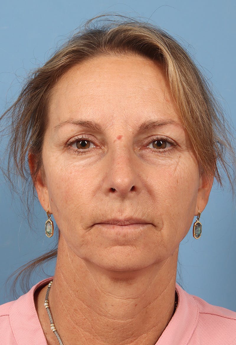 Rhinoplasty Before & After Gallery - Patient 115519 - Image 6