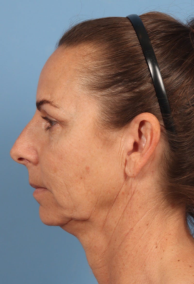 Rhinoplasty Before & After Gallery - Patient 115519 - Image 1