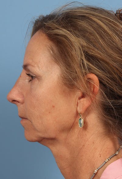 Rhinoplasty Before & After Gallery - Patient 115519 - Image 2