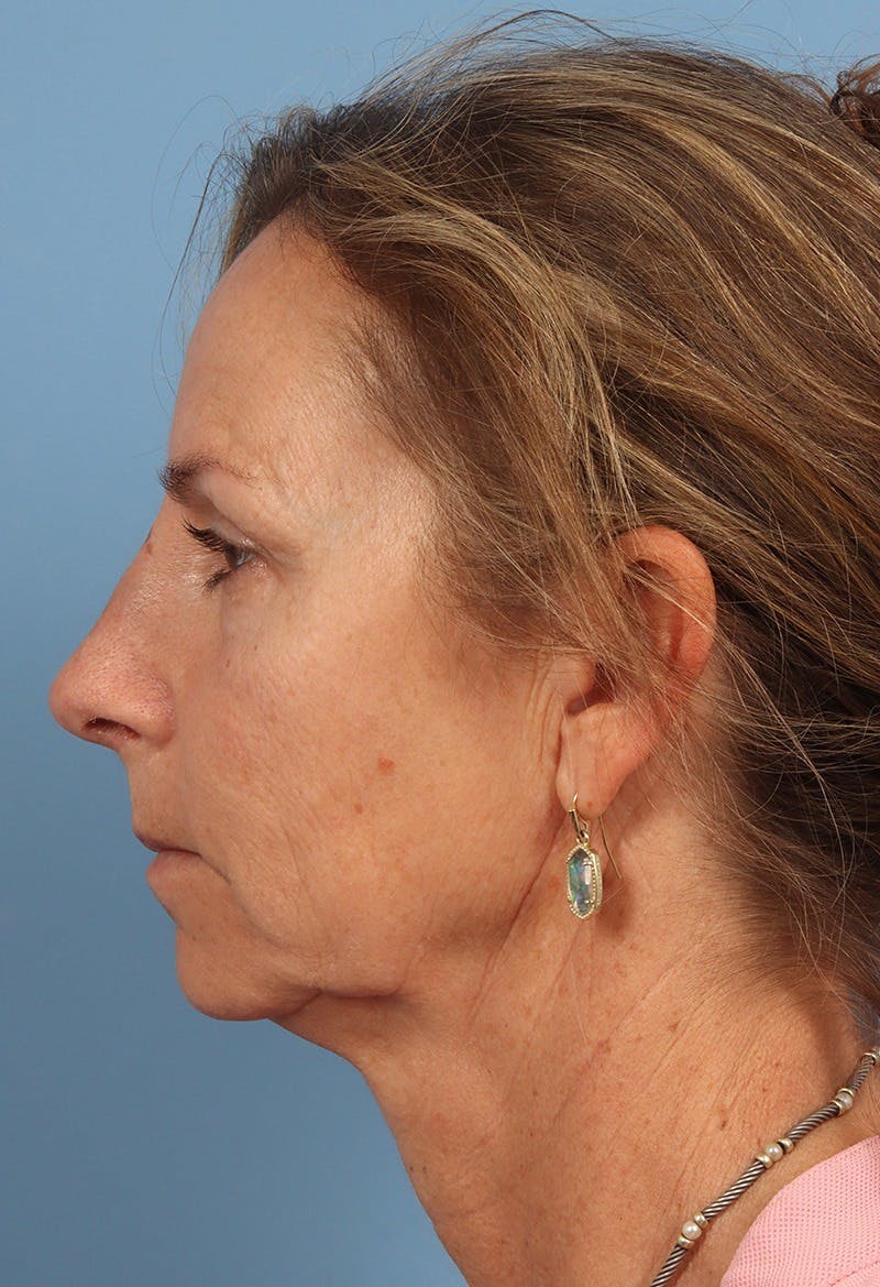 Rhinoplasty Before & After Gallery - Patient 115519 - Image 2