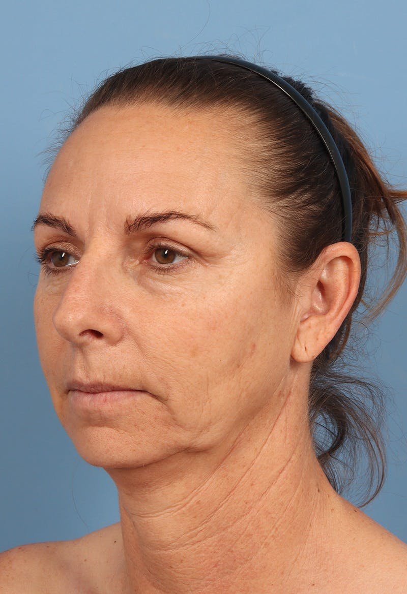 Rhinoplasty Before & After Gallery - Patient 115519 - Image 3