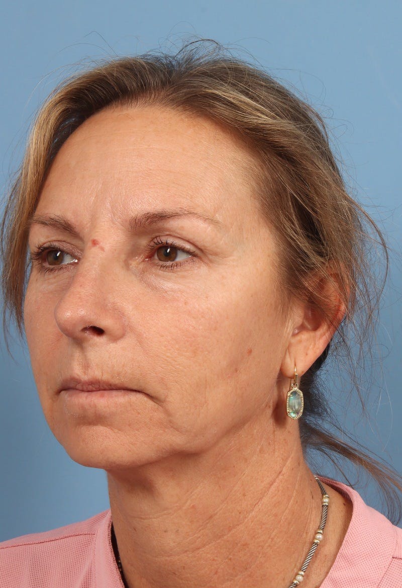 Rhinoplasty Before & After Gallery - Patient 115519 - Image 4