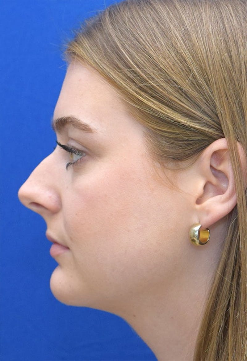 Rhinoplasty Before & After Gallery - Patient 141448 - Image 1