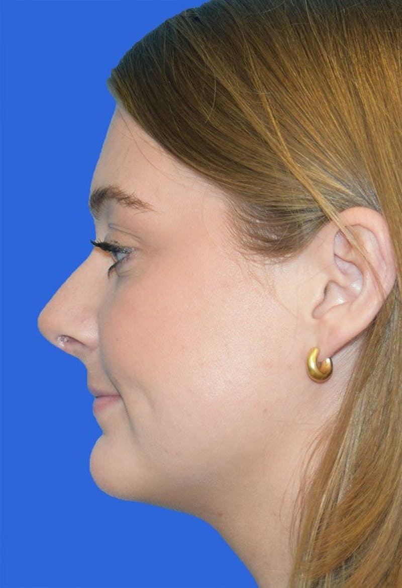 Rhinoplasty Before & After Gallery - Patient 141448 - Image 2