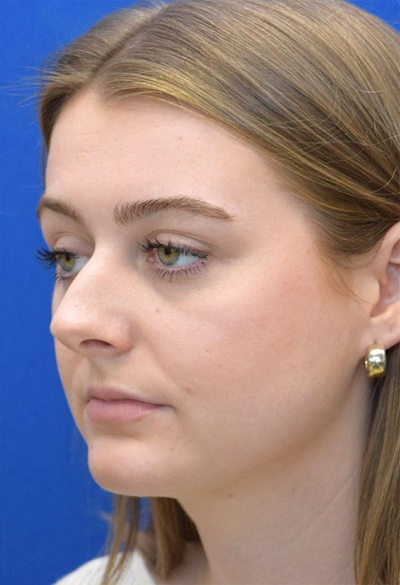 Rhinoplasty Before & After Gallery - Patient 141448 - Image 3