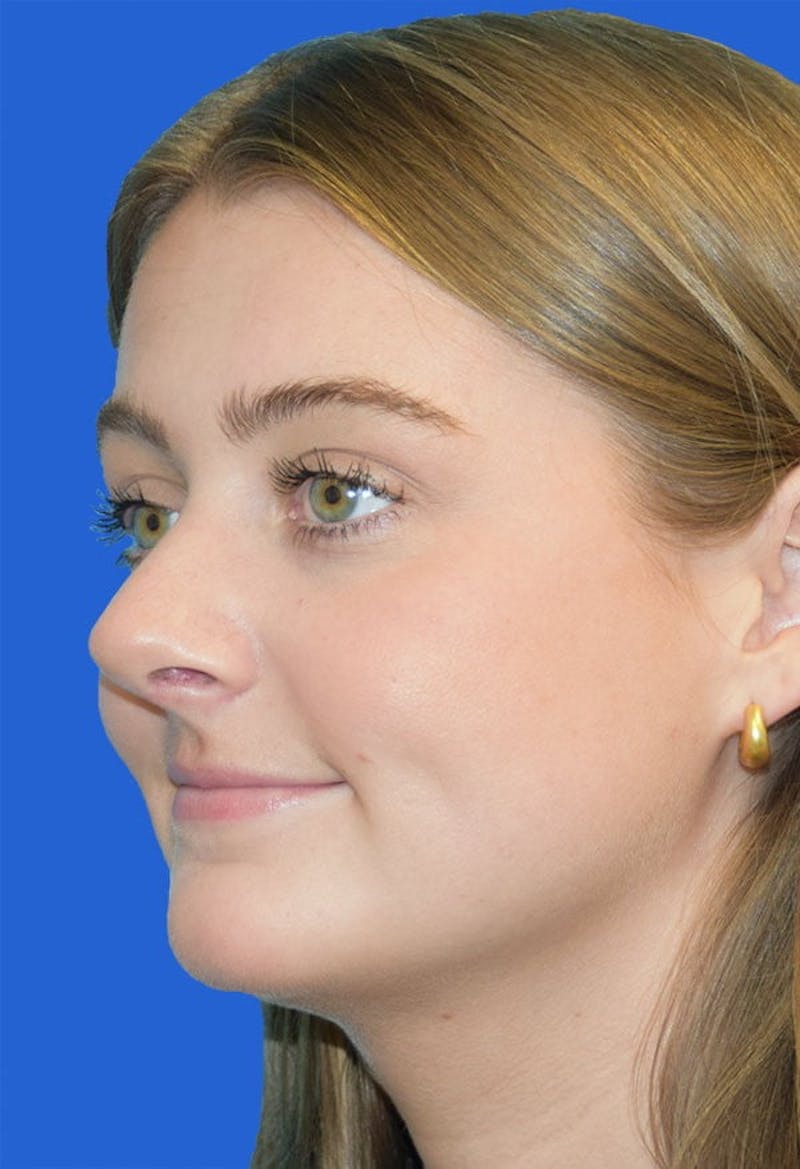 Rhinoplasty Before & After Gallery - Patient 141448 - Image 4