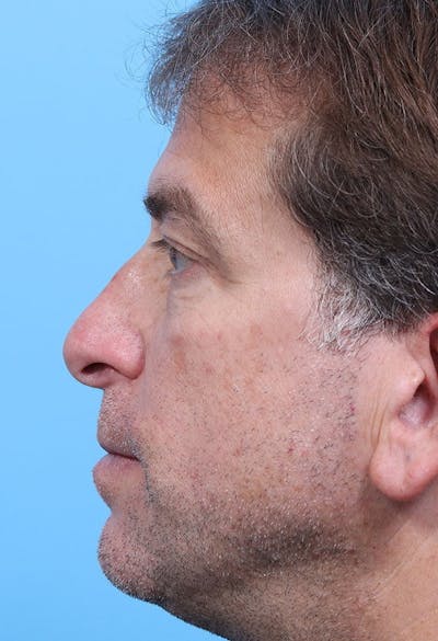 Rhinoplasty Before & After Gallery - Patient 139434 - Image 1