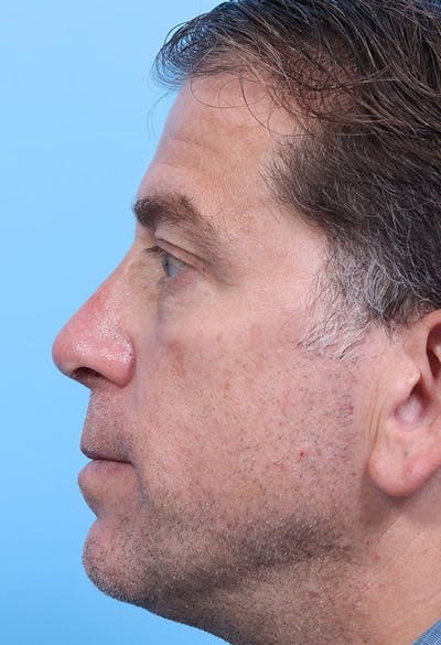 Rhinoplasty Before & After Gallery - Patient 139434 - Image 2