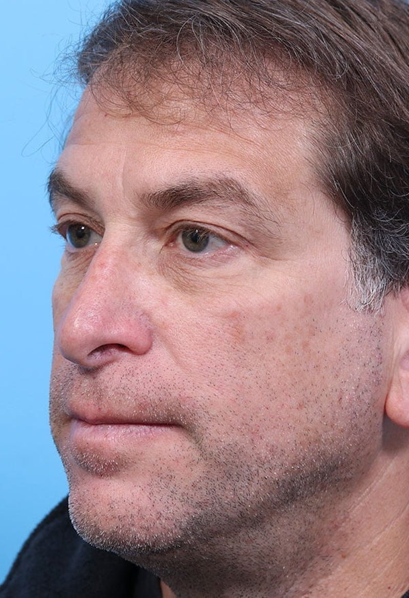 Rhinoplasty Before & After Gallery - Patient 139434 - Image 3