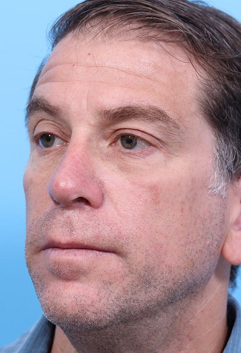 Rhinoplasty Before & After Gallery - Patient 139434 - Image 4