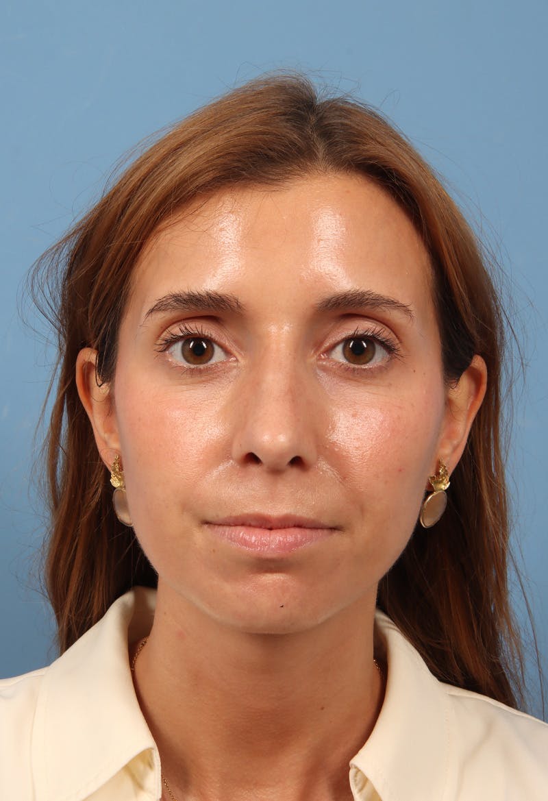 Rhinoplasty Before & After Gallery - Patient 369761 - Image 6