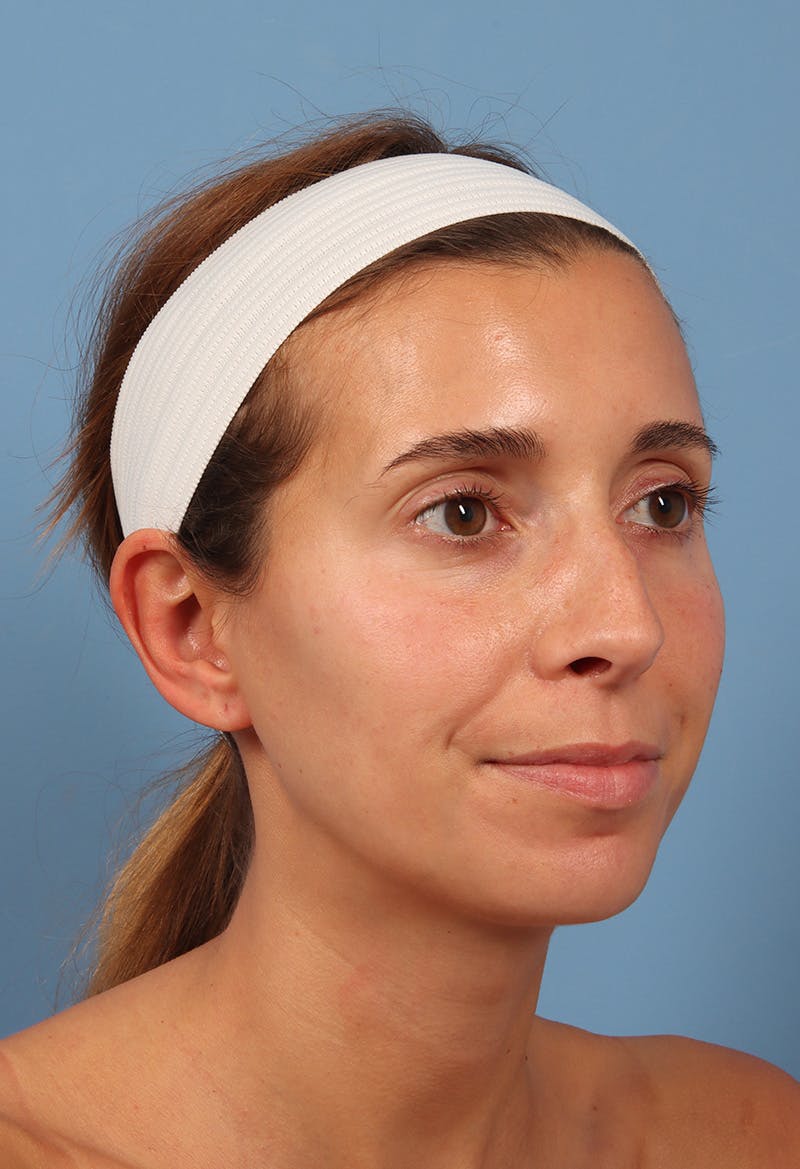 Rhinoplasty Before & After Gallery - Patient 369761 - Image 3