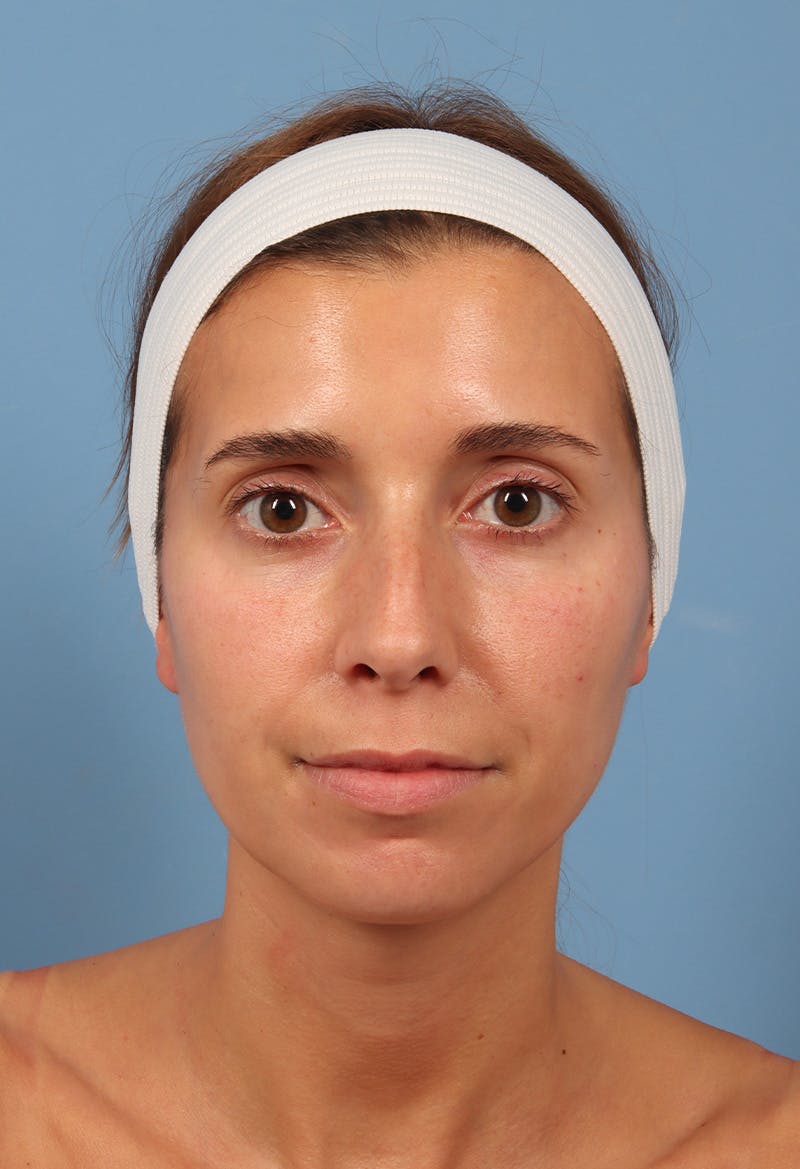 Rhinoplasty Before & After Gallery - Patient 369761 - Image 5