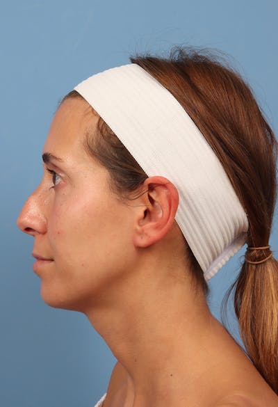 Rhinoplasty Before & After Gallery - Patient 369761 - Image 1