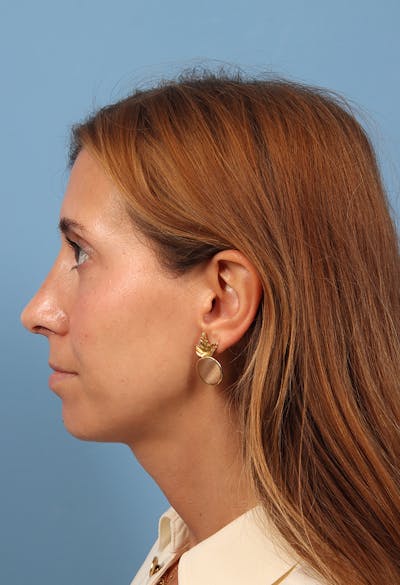 Rhinoplasty Before & After Gallery - Patient 369761 - Image 2
