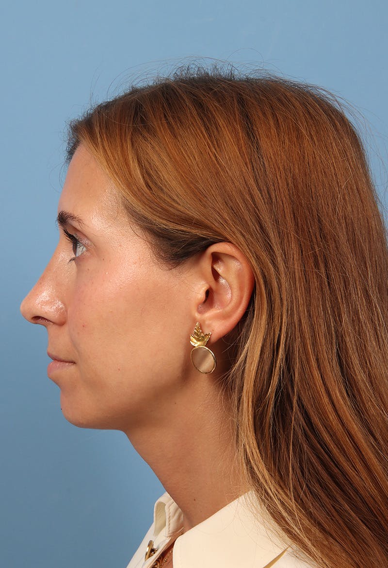 Rhinoplasty Before & After Gallery - Patient 369761 - Image 2