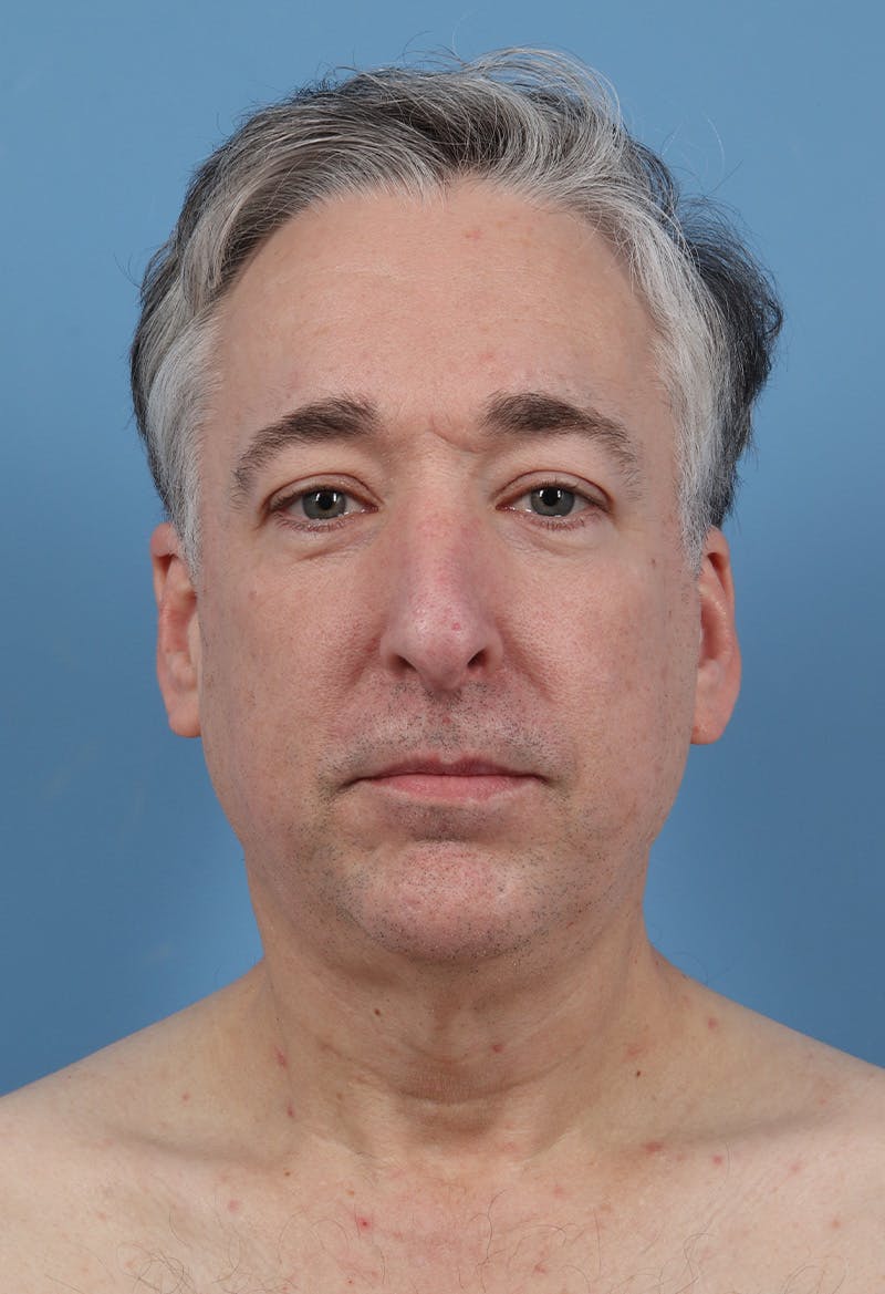 Rhinoplasty Before & After Gallery - Patient 554044 - Image 5