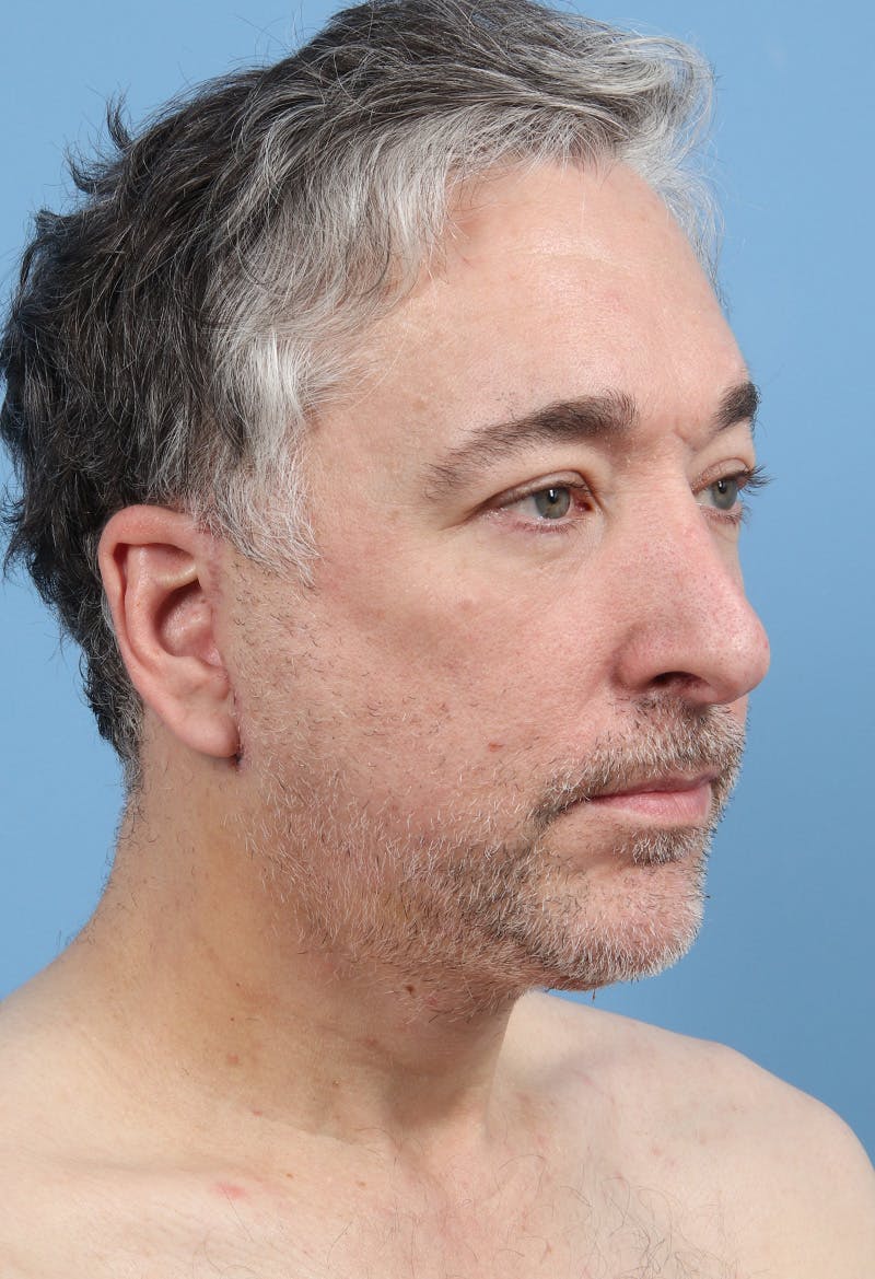 Rhinoplasty Before & After Gallery - Patient 554044 - Image 3