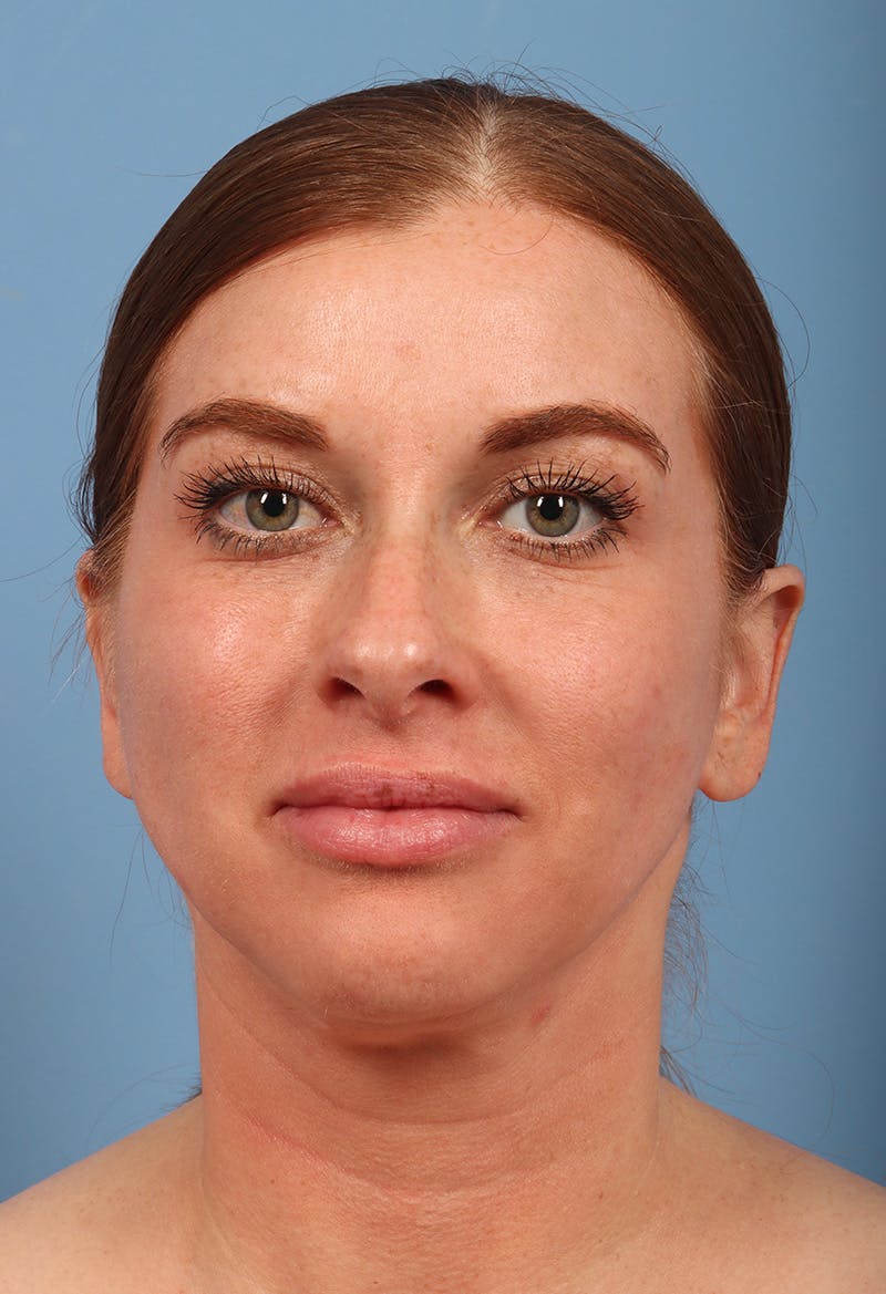Rhinoplasty Before & After Gallery - Patient 102242 - Image 5