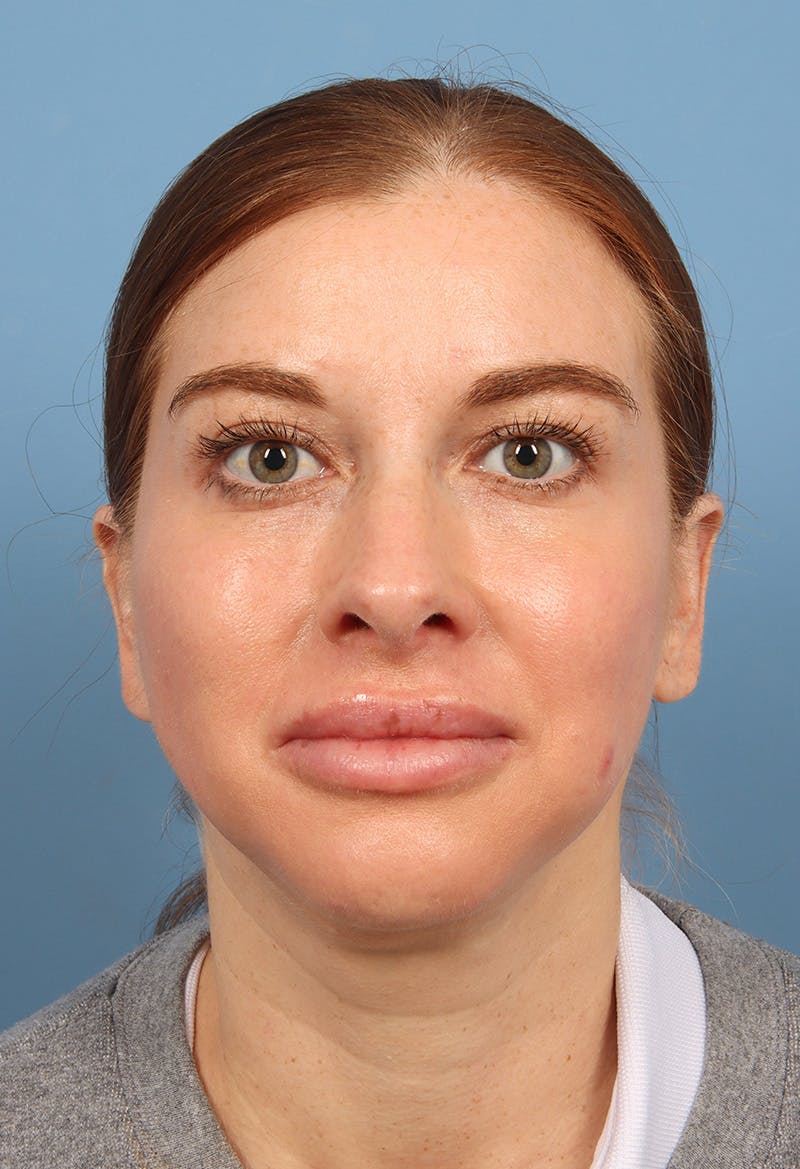 Rhinoplasty Before & After Gallery - Patient 102242 - Image 6