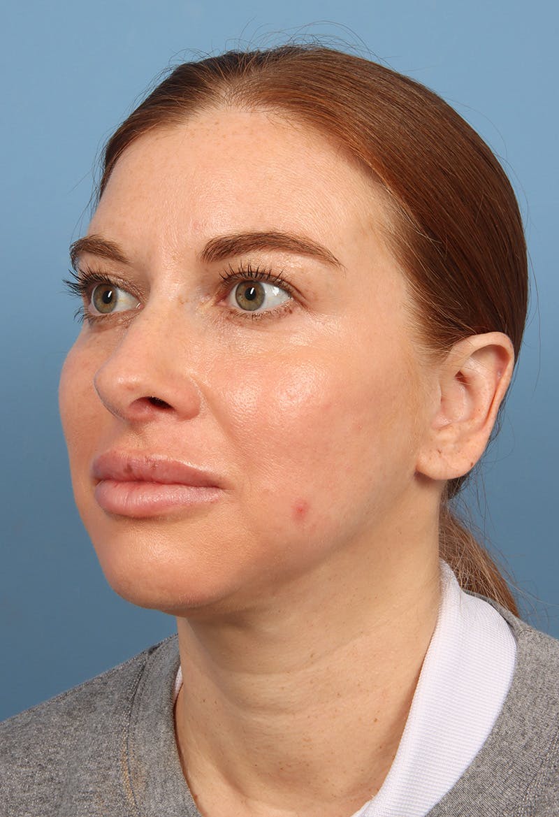 Rhinoplasty Before & After Gallery - Patient 102242 - Image 4
