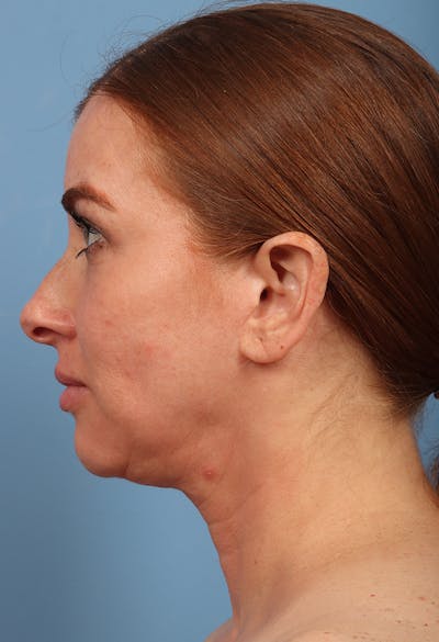 Rhinoplasty Before & After Gallery - Patient 102242 - Image 1