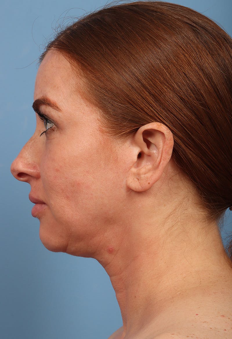 Rhinoplasty Before & After Gallery - Patient 102242 - Image 1