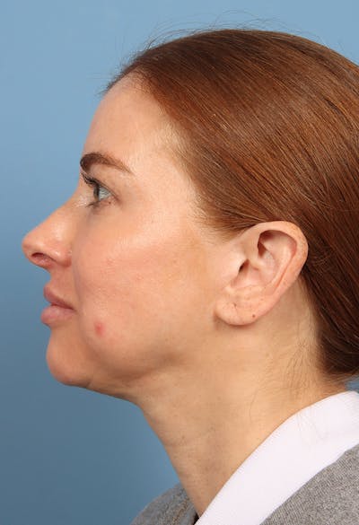 Rhinoplasty Before & After Gallery - Patient 102242 - Image 2