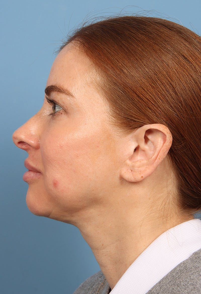 Rhinoplasty Before & After Gallery - Patient 102242 - Image 2