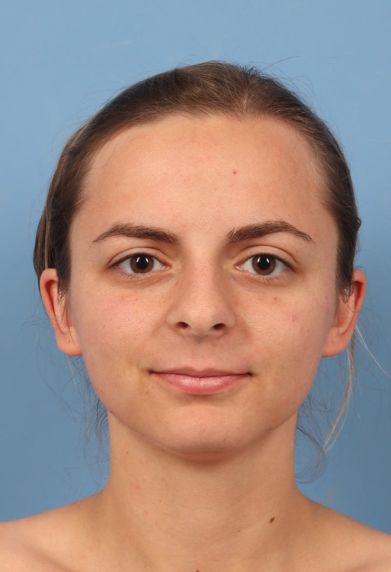 Rhinoplasty Before & After Gallery - Patient 302693 - Image 5