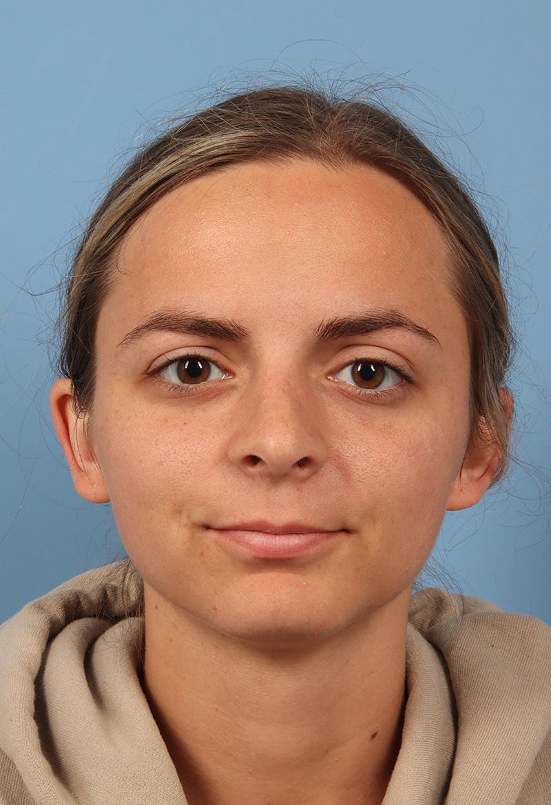 Rhinoplasty Before & After Gallery - Patient 302693 - Image 6