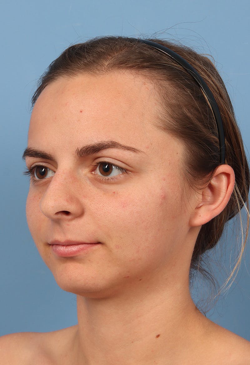 Rhinoplasty Before & After Gallery - Patient 302693 - Image 3