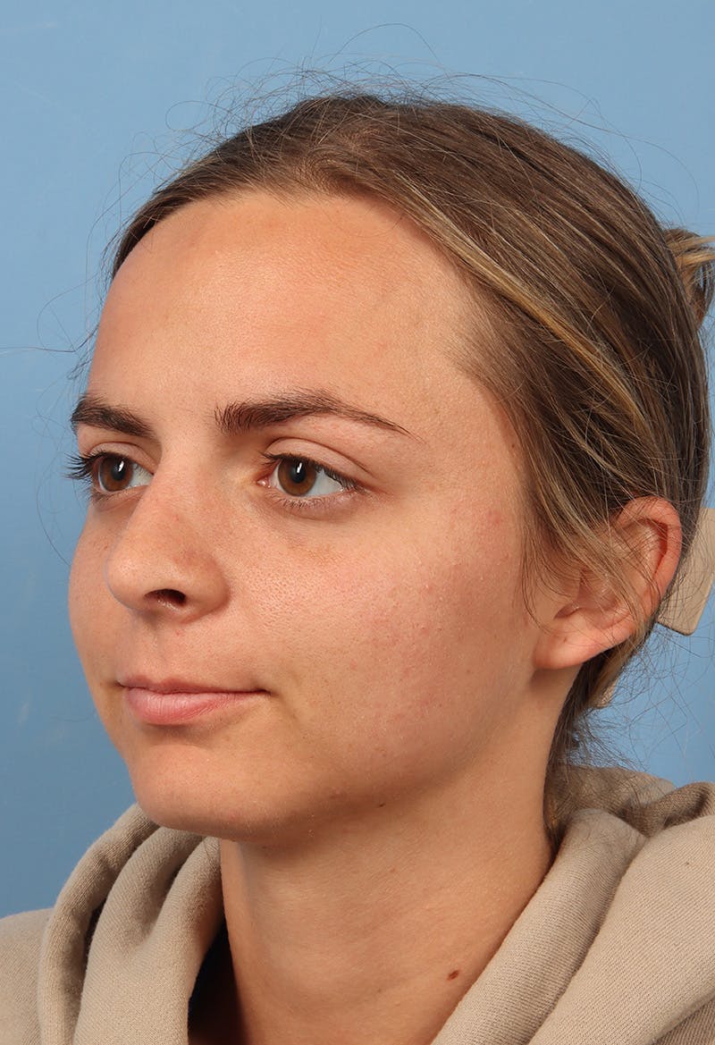 Rhinoplasty Before & After Gallery - Patient 302693 - Image 4
