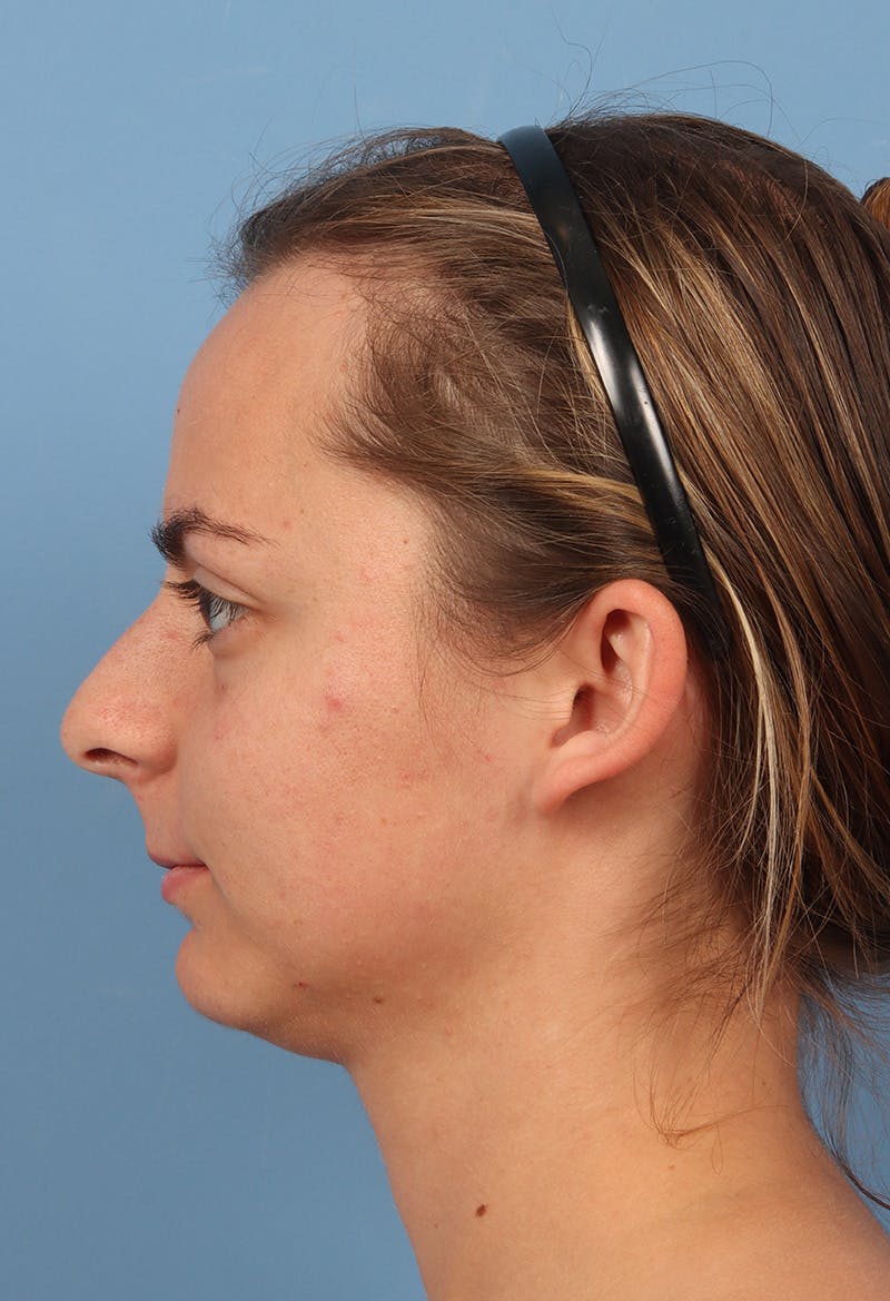 Rhinoplasty Before & After Gallery - Patient 302693 - Image 1