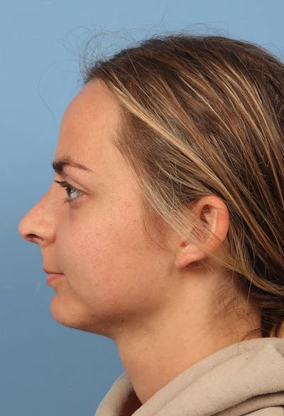 Rhinoplasty Before & After Gallery - Patient 302693 - Image 2