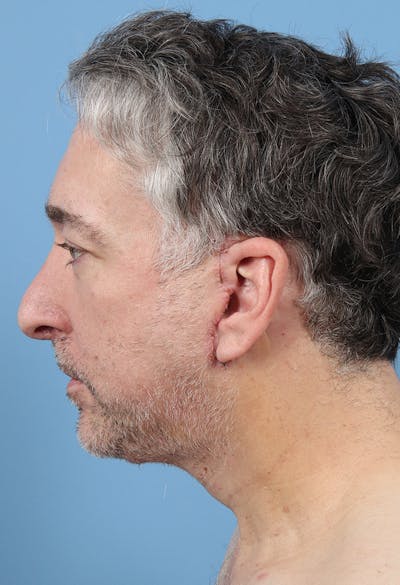 Rhinoplasty Before & After Gallery - Patient 554044 - Image 1