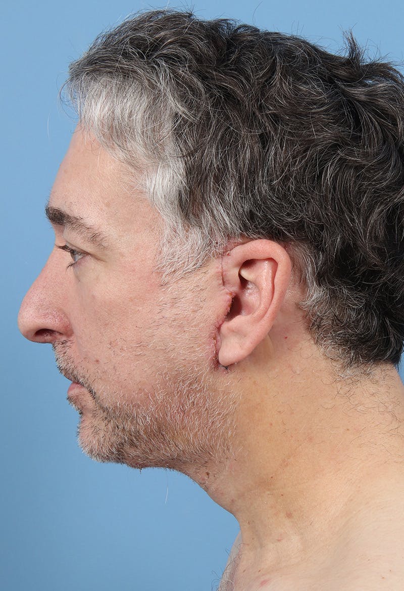 Rhinoplasty Before & After Gallery - Patient 554044 - Image 1