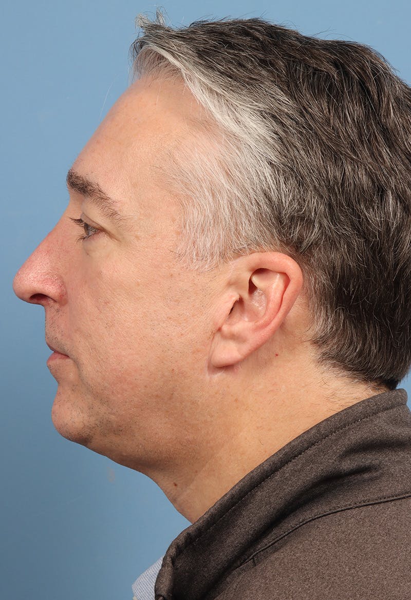 Rhinoplasty Before & After Gallery - Patient 554044 - Image 2