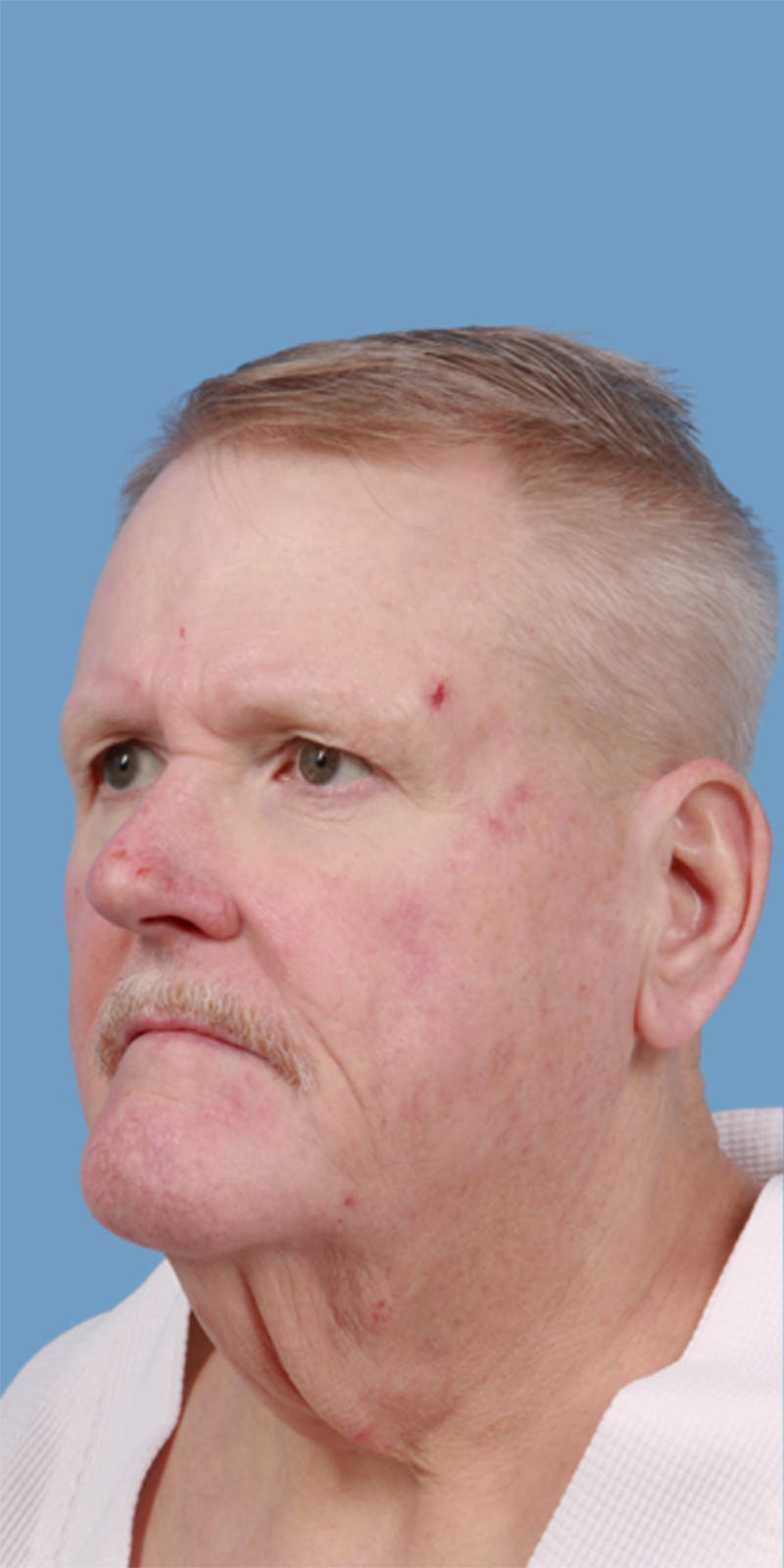 Facelift Before & After Gallery - Patient 316000 - Image 1