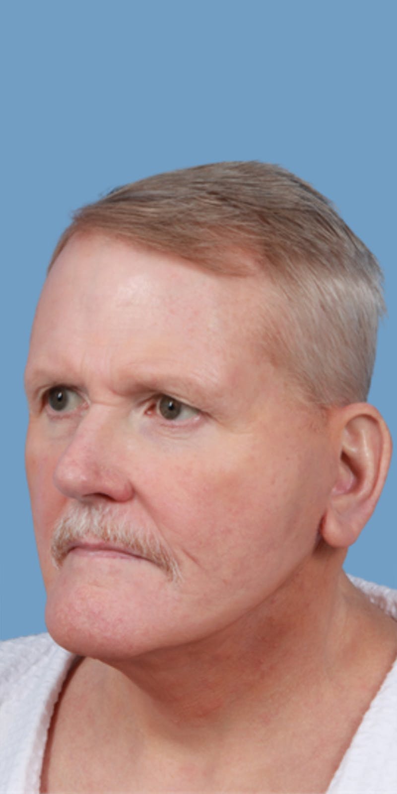 Facelift Before & After Gallery - Patient 316000 - Image 2