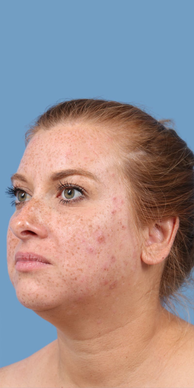 Facelift Before & After Gallery - Patient 179644 - Image 1
