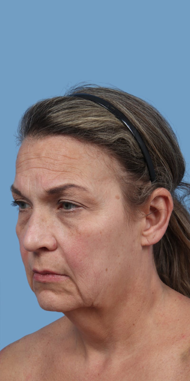 Facelift Before & After Gallery - Patient 370488 - Image 1