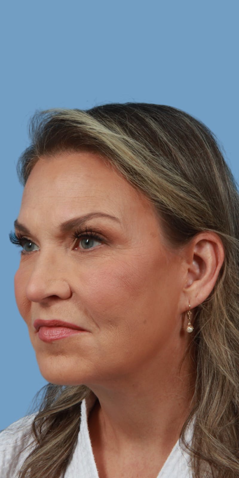 Facelift Before & After Gallery - Patient 370488 - Image 2