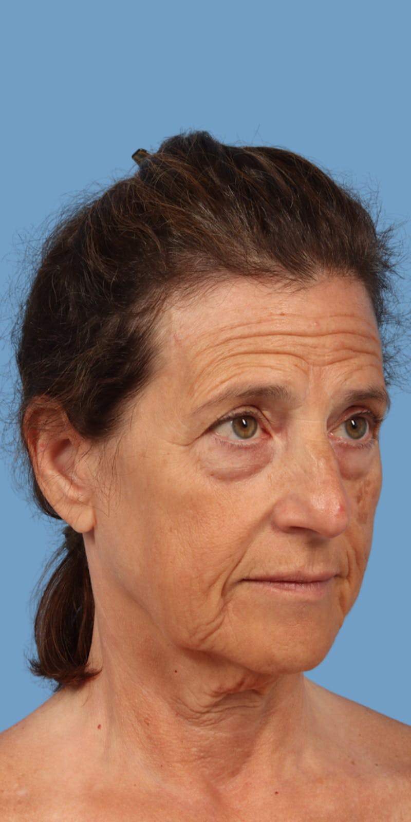 Facelift Before & After Gallery - Patient 101039 - Image 1