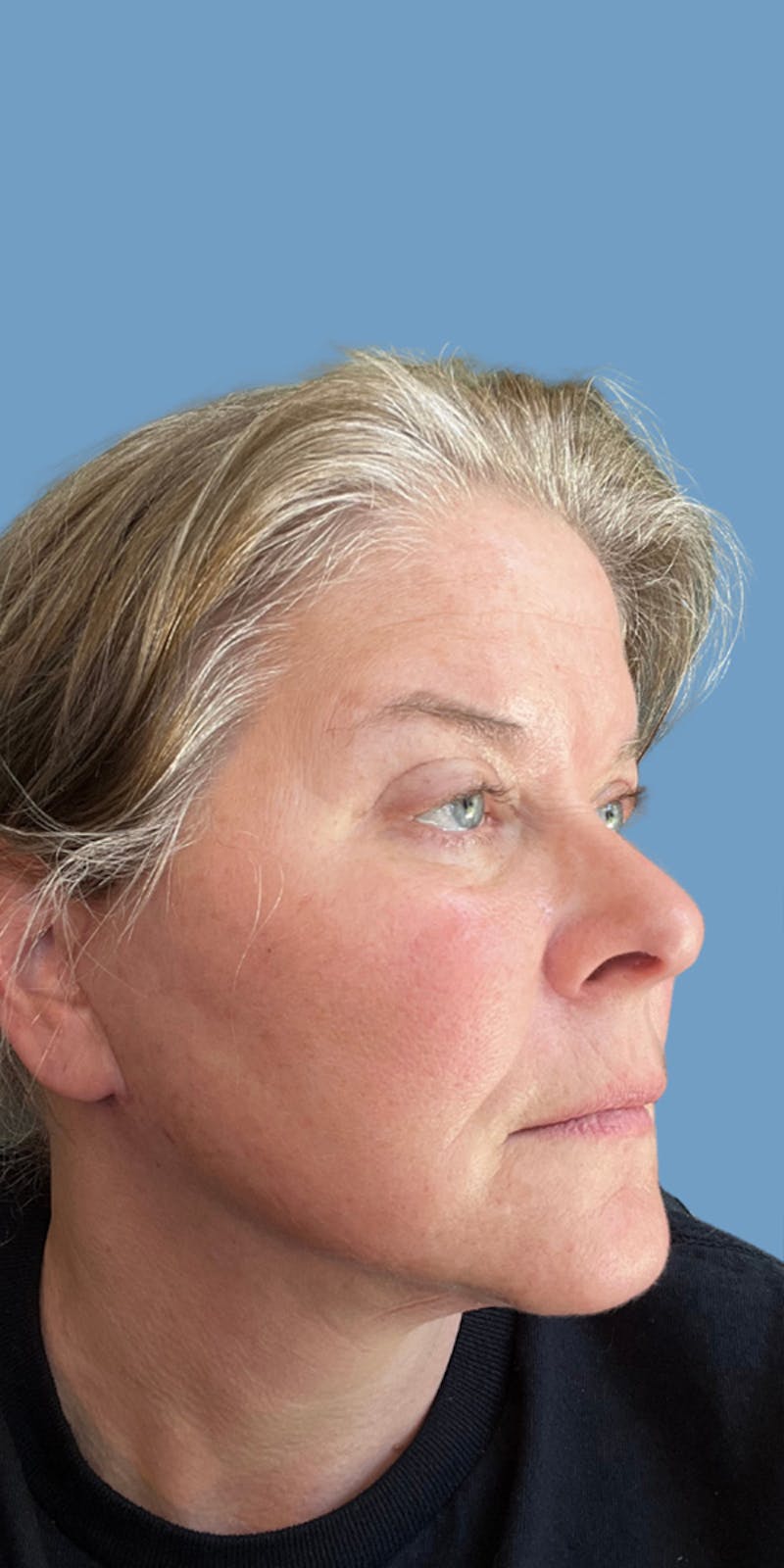 Facelift Before & After Gallery - Patient 365520 - Image 2