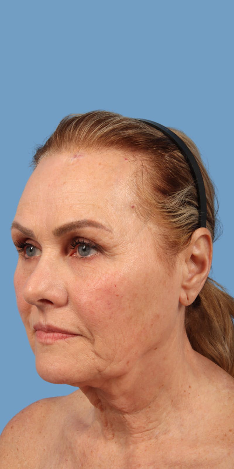 Facelift Before & After Gallery - Patient 196605 - Image 1